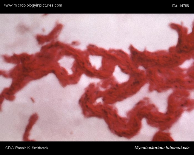 Mycobacterium tuberculosis cording acid-fast stain, cording